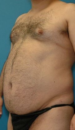 Before Image: Liposuction: Case 6 - left-front-oblique