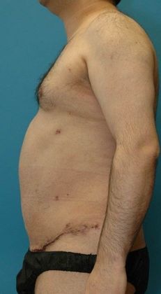 After Image: Liposuction: Case 6 - left-side