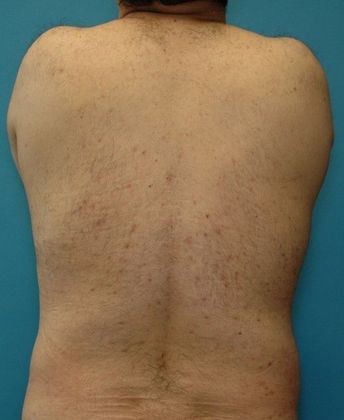 After Image: Liposuction: Case 6 - back