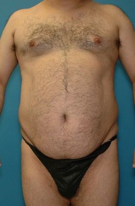 Before Image: Liposuction: Case 6 - front