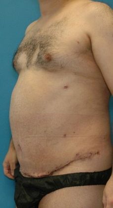 After Image: Liposuction: Case 6 - left-front-oblique