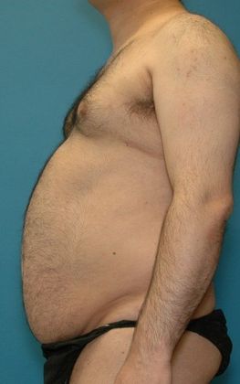Before Image: Liposuction: Case 6 - left-side