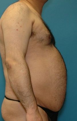 Before Image: Liposuction: Case 6 - right-side