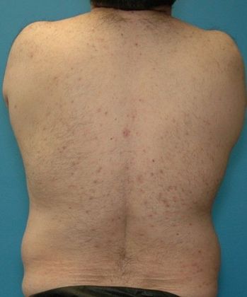 Before Image: Liposuction: Case 6 - back
