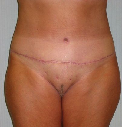 After Image: Body Lifts: Case 6 - front