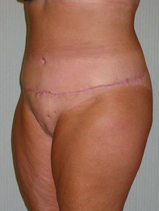 After Image: Body Lifts: Case 6 - left-front-oblique