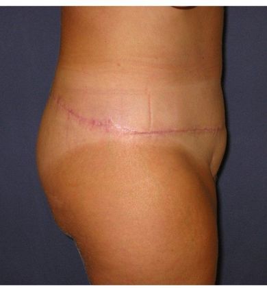After Image: Body Lifts: Case 6 - right-side