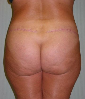 After Image: Body Lifts: Case 6 - back