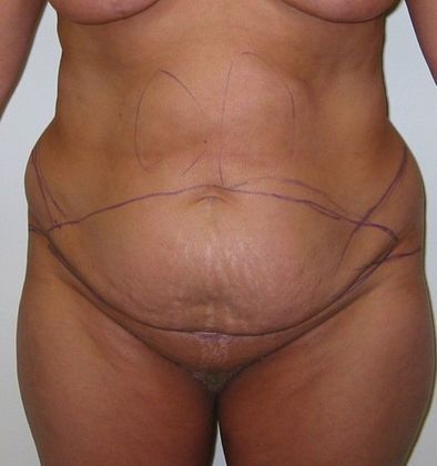 Before Image: Body Lifts: Case 6 - front