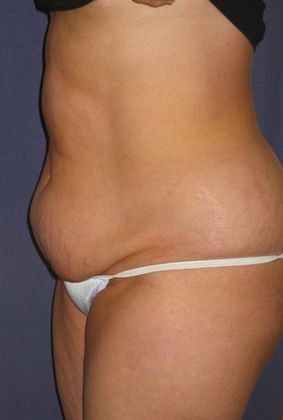 Before Image: Body Lifts: Case 6 - left-front-oblique