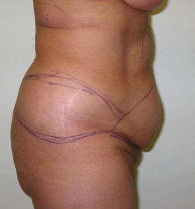 Before Image: Body Lifts: Case 6 - right-side