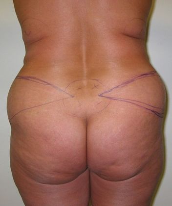 Before Image: Body Lifts: Case 6 - back