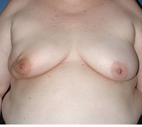 Before Image: Breast Reconstruction: Case 6 - front