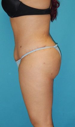 After Image: Brazilian Butt Lift: Case 6 - left-side