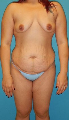 Before Image: Brazilian Butt Lift: Case 6 - front
