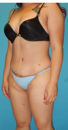 Before Image: Brazilian Butt Lift: Case 6 - left-front-oblique