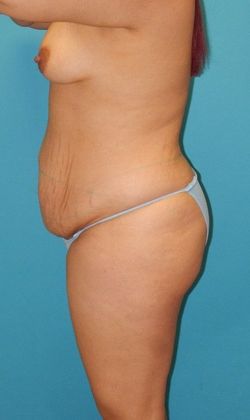 Before Image: Brazilian Butt Lift: Case 6 - left-side