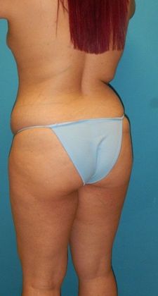 Before Image: Brazilian Butt Lift: Case 6 - left-back-oblique