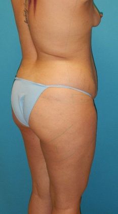 Before Image: Brazilian Butt Lift: Case 6 - right-back-oblique