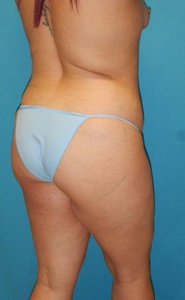 Before Image: Brazilian Butt Lift: Case 6 - right-back-oblique