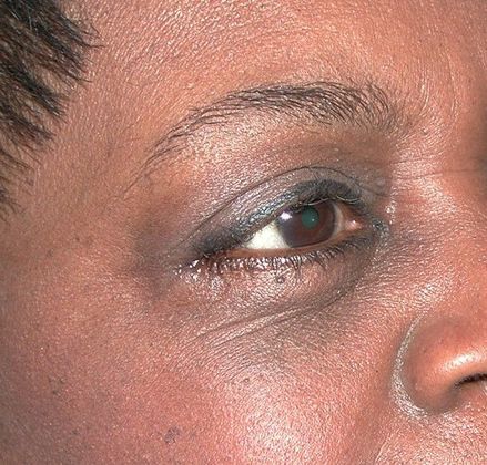 After Image: Eye Lift (Blepharoplasty): Case 6 - right-front-oblique