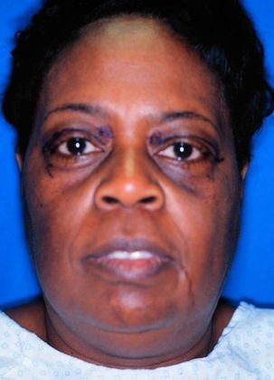 Before Image: Eye Lift (Blepharoplasty): Case 6 - front
