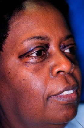 Before Image: Eye Lift (Blepharoplasty): Case 6 - right-front-oblique