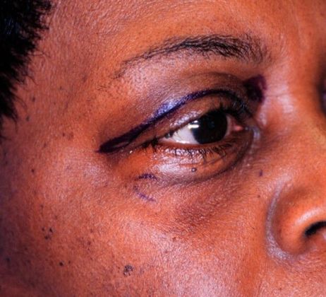 Before Image: Eye Lift (Blepharoplasty): Case 6 - right-front-oblique