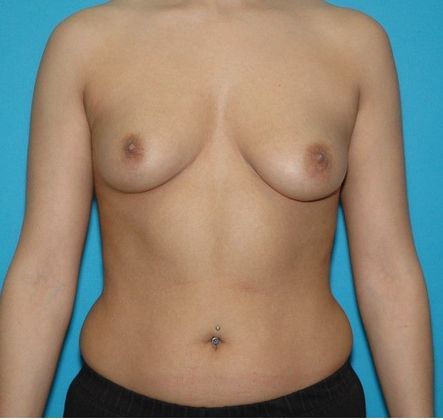 Before Image: Breast Augmentation: Case 6 - front