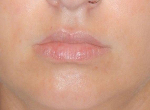 After Image: Soft Tissue Fillers: Case 6 - front