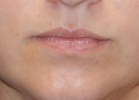 Before Image: Soft Tissue Fillers: Case 6 - front