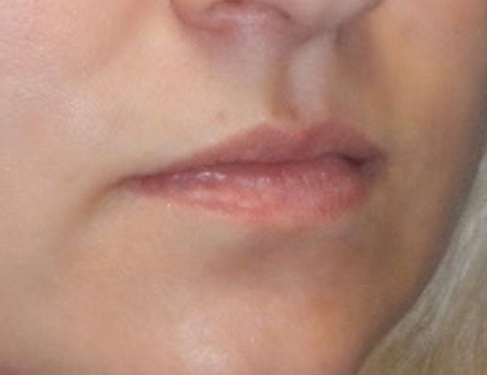 Before Image: Soft Tissue Fillers: Case 6 - right-front-oblique