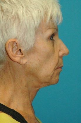 After Image: Fat Grafting Face: Case 6 - right-side