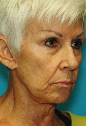 Before Image: Fat Grafting Face: Case 6 - right-front-oblique