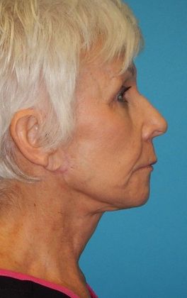 Before Image: Fat Grafting Face: Case 6 - right-side