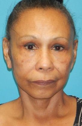 After Image: Neck Lift: Case 6 - front