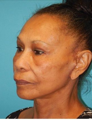 After Image: Neck Lift: Case 6 - left-front-oblique