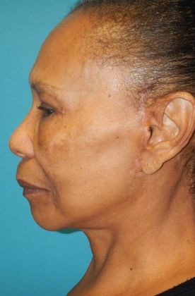 After Image: Neck Lift: Case 6 - left-side