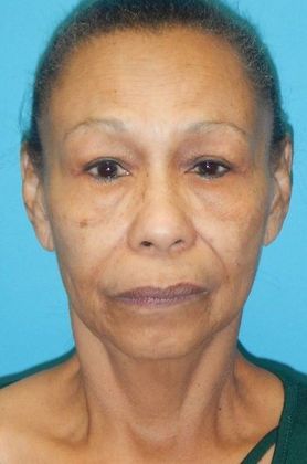 Before Image: Neck Lift: Case 6 - front