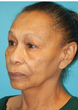 Before Image: Neck Lift: Case 6 - left-front-oblique