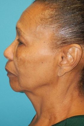 Before Image: Neck Lift: Case 6 - left-side