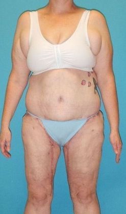 After Image: Thigh Lift: Case 6 - front