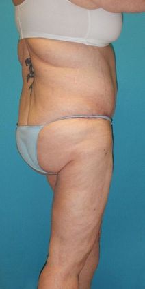 After Image: Thigh Lift: Case 6 - right-back-oblique