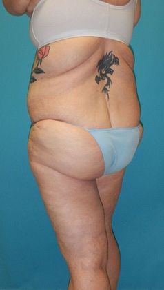 After Image: Thigh Lift: Case 6 - left-back-oblique