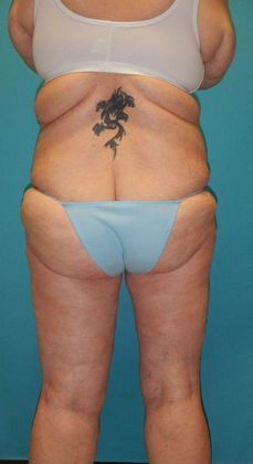 After Image: Thigh Lift: Case 6 - back