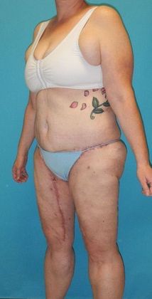 After Image: Thigh Lift: Case 6 - left-front-oblique