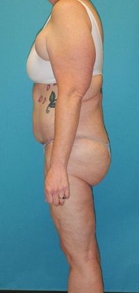 After Image: Thigh Lift: Case 6 - left-side