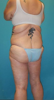 After Image: Thigh Lift: Case 6 - left-back-oblique
