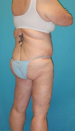 After Image: Thigh Lift: Case 6 - right-back-oblique