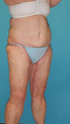 After Image: Thigh Lift: Case 6 - right-front-oblique